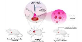 Image result for Myocardial Infarction Stabilization