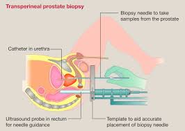 When malignant cancer cells form and grow within a person's breast tissue, breast cancer occurs. Prostate Cancer Surgery Oxford International Edition