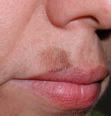 Image result for Solar Lentigo