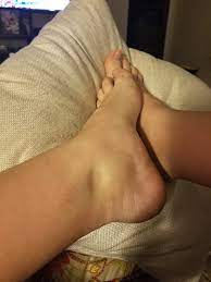 Pitting Edema July 2018 Babies Forums What To Expect