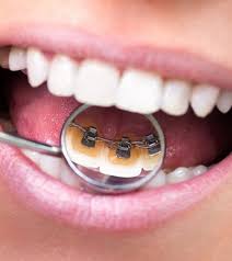 What Can Braces Fix? - Bracesetters Orthododontics