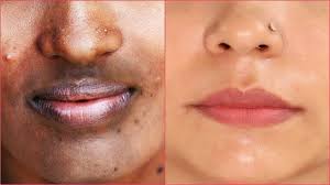 The dark spots can be moles, birthmarks, burn marks, or skin discoloration. How To Remove Dark Patches Spots Hyper Pigmentation Around Your Mouth Fast Naturally Youtube