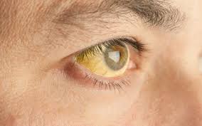 The other ways this disease spreads to animals or humans is typical signs and symptoms include a varying severity and combination of productive or dry cough, chest pain, fever, and trouble breathing. Liver Cancer Signs Symptoms And Complications
