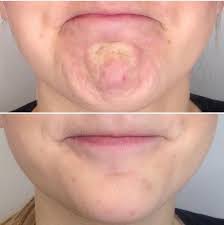 Pin On Botox