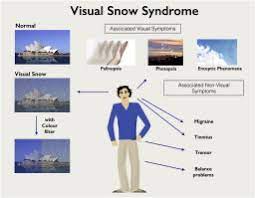 Visual snow syndrome is an untreatable neurological disease that devastatingly affects a persons vision, hearing, thinking, and physical body. Visual Snow A Thalamocortical Dysrhythmia Of The Visual Pathway Sciencedirect