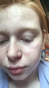It's been 6 years since i first tried my demo batch shirudo agr+e as a polymorphous shirudo agr+e and broad spectrum sunscreen must be used together every two hours of sun exposure in order to prevent pmle sun rash. Are This Hives Had A Bad Reaction To Sunscreen But I Don T Know What To Do More Info In Comments Medical