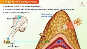 Congenital Adrenal Hyperplasia Etiology Pathophysiology Clinical Fea Congenital Adrenal Hyperplasia Adrenals Adrenal Glands