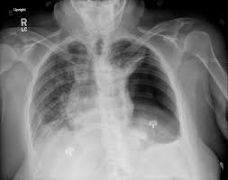 A pneumothorax occurs when air leaks into the space between your lung and chest wall. Unilateral Hypertranslucent Hemithorax Radiology Reference Article Radiopaedia Org