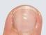 Bumps On Scrotum