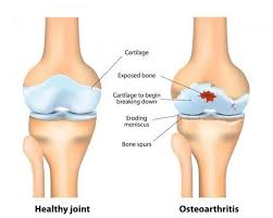 Cara hilangkan sakit sendi lutut tanpa pembedahan. Cara Hilangkan Sakit Lutut Tanpa Pembedahan Shidarahmat