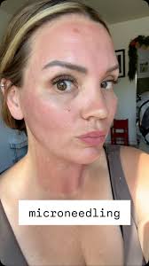 A little bts 💉 🩸, @urbanunwindspa , #microneedling #botox #medspas