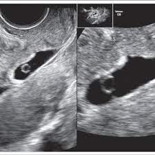 6 weeks pregnant belly pictures. Transvaginal Ultrasound Image Of A Cesarean Scar Pregnancy At 6 Weeks Download Scientific Diagram