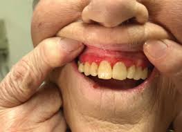 Most often it happens in people between ages 15 and 45 years. Dermatologic Manifestations In The Oral Mucosa The Dermatologist