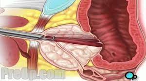 To update the complications of transurethral resection of the prostate (turp), including management and prevention based on technological evolution. Turp Transurethral Resection Prostate Patient Education Youtube