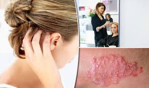 Many people see a dermatologist for treatment. Psoriasis Treatment For Scalp Charles Worthington Master Stylist Reveals Detox Cure Express Co Uk