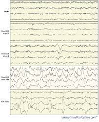 Sleep Physiology Myvmc Sleep Lab Sleep Medicine Sleep Therapy