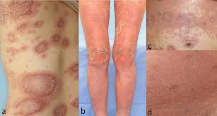Image result for Pustular Psoriasis