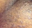 Pulled Out Infected Hair Follicle