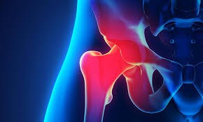 Image result for Hip Dislocation