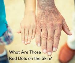 What are the causes of petechiae? What Are Those Red Dots On The Skin Senioradvisor Com Blog