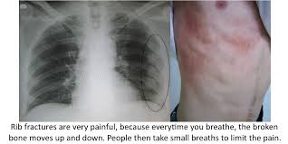 Rib Fractures Rib Fracture Broken Ribs Bruised Ribs