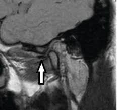 Slipped discs can be caused by a strain or an injury. Internal Derangements Of The Temporomandibular Joint Diagnosis And Management Intechopen