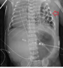 Chest X-ray of the congenital diaphragmatic hernia (arrow ...