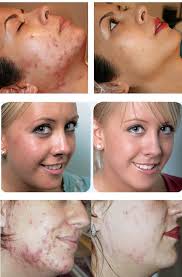 Wat Doet Glycolzuur Peeling Met De Huid Alfa Hydroxy Acids Zijn O A Bekend Als Appelzuur Appels Citroen Chemical Peel Chemical Skin Peel Beauty Tips Eyes