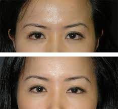 Others may require surgery after an accident, following weight loss or after pregnancy and childbirth. Temporal Brow Lift Lateral Temporal Lift Mini Brow Lift
