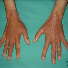 Hyperpigmentation Was Observed On The Skin Grafts Of All Patients Download Scientific Diagram