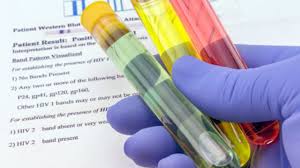 Testarea pentru its este importanta intrucat o persoana poate avea o infectie fara sa cunoasca acest lucru (in majoritatea cazurilor, nu exista semne sau. Boli Cu Transmitere Sexuala Simptome Tratamente Specifice