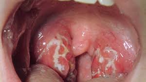 Pain in your ears or neck. Rash And Sore Throat Pictures Causes And Treatments