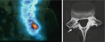 Nuclear Medicine Imaging Of Spine Injuries Radiology Key
