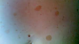 Blickdiagnosen Von Der Mutter Geerbt Braune Flecken Am Ganzen Korper Springermedizin De