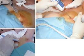 A biopsy is the removal of a sample of tissue from the body for examination. Ultrasound Guided Core Needle Biopsy Of Breast Lesions Insights Into Imaging Full Text