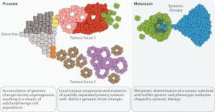 Prostate cancer can recur locally (in the area immediately surrounding the prostate) or distantly (anywhere else in the body). Genomic And Phenotypic Heterogeneity In Prostate Cancer Nature Reviews Urology