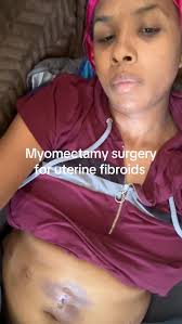 There is an update. Got my myomectomy surgery Monday. Today is Wednesday.  I’m still in a lot of pain. My stomach is swollen. It hurts to move, etc.  But my fibroids were extremely large