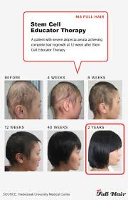 9 in the second study, 5 percent minoxidil. Stem Cell Hair Loss Treatment
