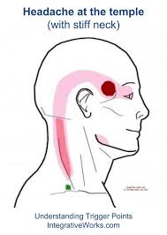 Headache At Your Temple With Stiff Neck Integrative Works Headache Remedies Headache Relief Migraine Trigger Points