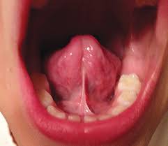 Wow guys my tongue grew in minuets with this ancient exercise!! Is Your Tongue Causing Your Health Problems Oral Health Group