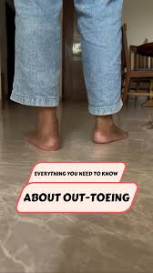 Image result for Out-toeing