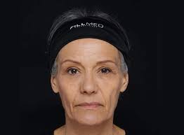 ART FILLER: Wrinkle filler & Hyaluronic Acid Dermal Fillers