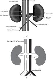 Figure 1 From The Retroaortic Left Renal Vein Abnormalities In Cross Sectional Imaging Semantic Scholar