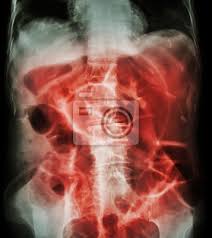 Bowel obstruction, also known as intestinal obstruction, is a mechanical or functional obstruction of the intestines which prevents the normal movement of the products of digestion. Darmverschluss Rontgenabdomen Ruckenlage Dickdarm Leinwandbilder Bilder Erweitern Magen Bauchschmerzen Myloview De