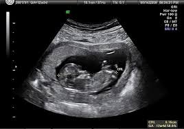 Enjoy the videos and music you love, upload original content, and share it all with friends, family, and the world on youtube. Jenis Kelamin Hasil Gambar Usg Bayi Laki Laki