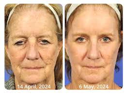 Flysmus™ WhiteSpots Threapy Bee Venom Eye Cream