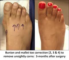 When you choose to have co. Cosmetic Foot Surgery Home Facebook