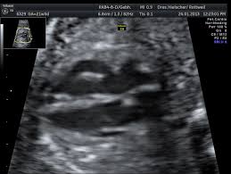 Die feindiagnostik, auch sonografische feindiagnostik, feinultraschall, fehlbildungsultraschall oder organscreening genannt, ist kein bestandteil der pränatalen vorsorgeuntersuchungen im rahmen. Feindiagnostik