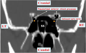 Learn about sphenoid sinus with free interactive flashcards. Ajns African Journal Of Neurological Sciences Evaluation Of The Clinico Anatomical Relationships Between Onodi Cells Optic Nerve And The Sphenoid Sinus Using Tomographic Imaging