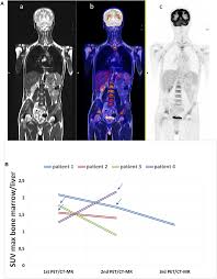 Nazim othman, fasha sandha, jasmin hamid, dayana roza, shahrizal jaszle, afzan a.rahman, maria farida, eizlan yusof, ainul aishah, adam lee,dian p.ramlee. Frontiers 18f Fluorodeoxyglucose Positron Emission Tomography And Computed Tomography With Magnetic Resonance For Diagnosing Adult Onset Still S Disease Medicine